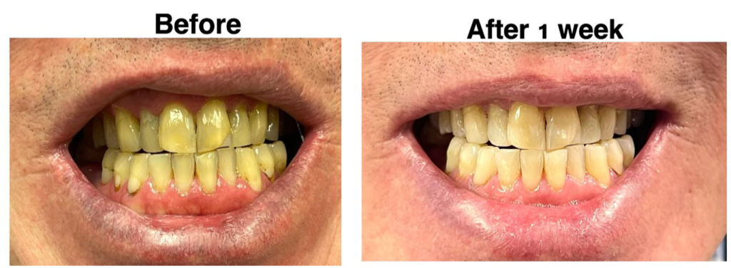 teeth whitening before and after - scranton pa dentist