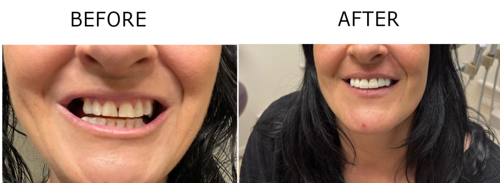 veneers before and after - scranton pa dentist